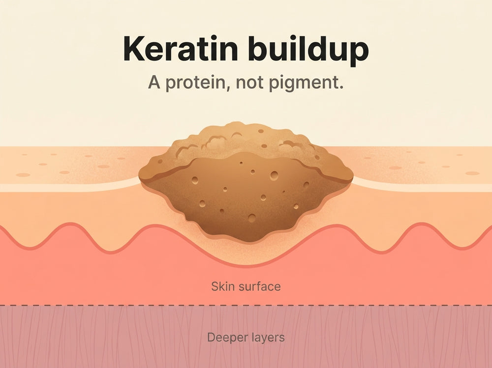 Diagram of keratin buildup sitting on the skin surface
